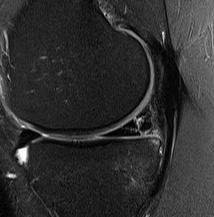 Medial Meniscus Posterior Horn Tear